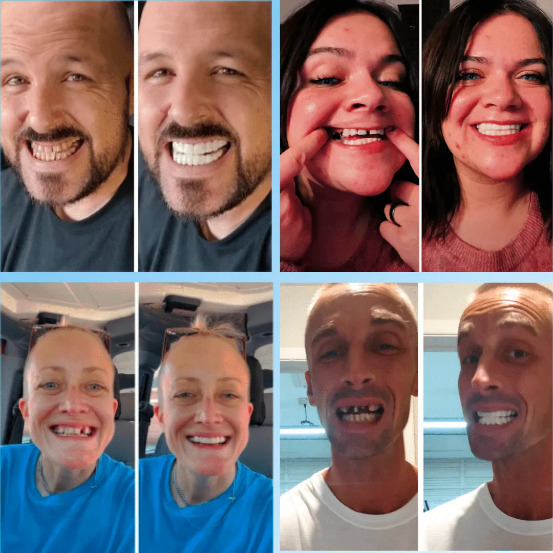 Snap On Smile: реттелетін протездер (Copy)