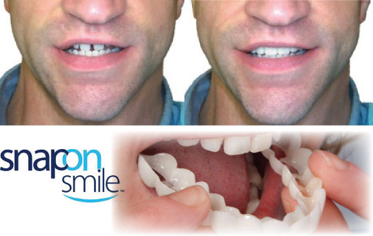 Snap On Smile: реттелетін протездер (Copy)